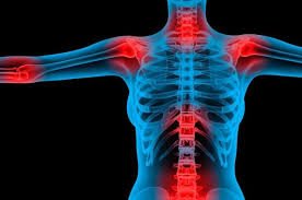 dor fibromialgia costas articulações